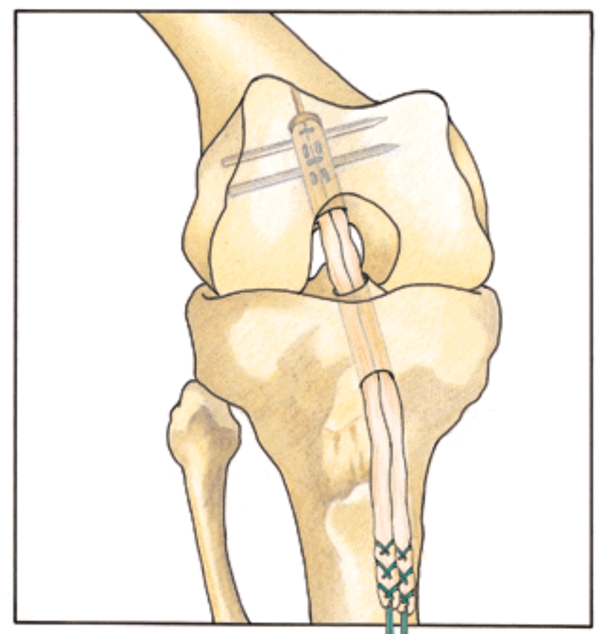 Симптомы крестообразной связки коленного сустава. Артропластика ПКС коленного сустава. Артроскопическая реконструкция передней крестообразной связки. Связка для надколенника для ПКС. Крестообразные связки надколенника.